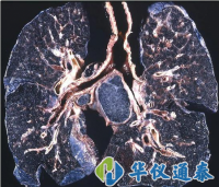 你知道什么是塵肺病嗎？使用粉塵儀可以降低塵肺病的發(fā)生率